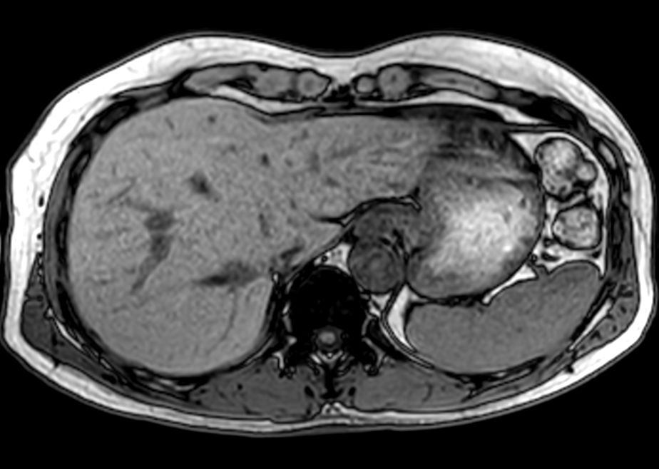 Axial Dual FFE (Out Phase)