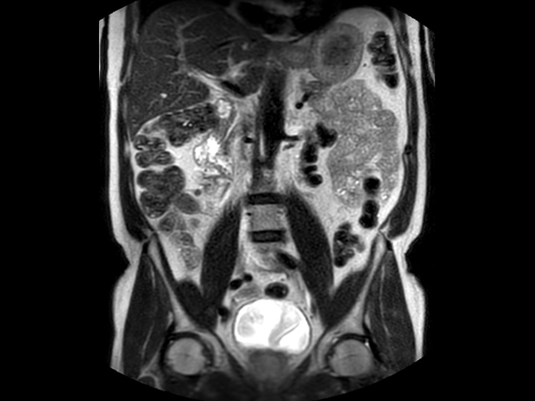 Coronal T2w TSE (1 station)<b>Abdomen Pelvis - Single coil</b>