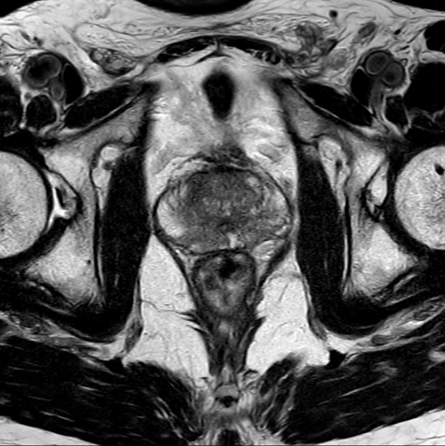 Axial T2w TSE (PI-RADS)<p>Compressed SENSE</p>