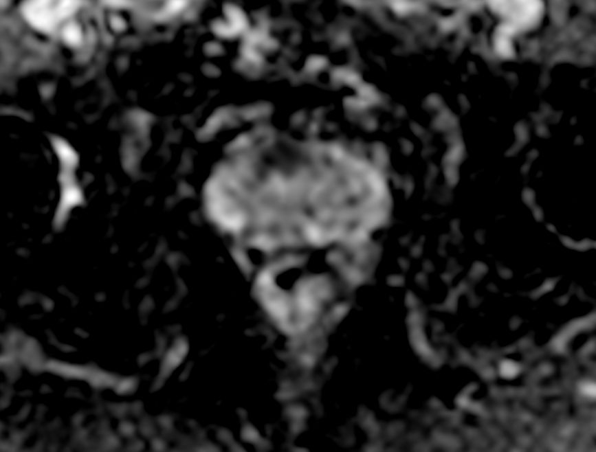 Axial Diffusion (ADC)