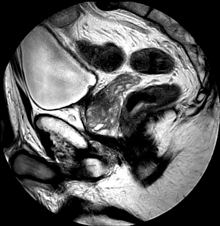 Sagittal T2w TSE MultiVane XD