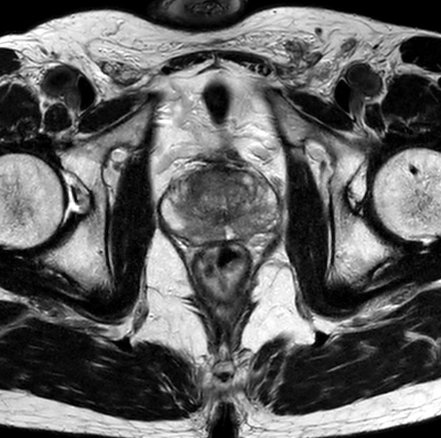 Axial T2w TSE<p>Compressed SENSE</p>