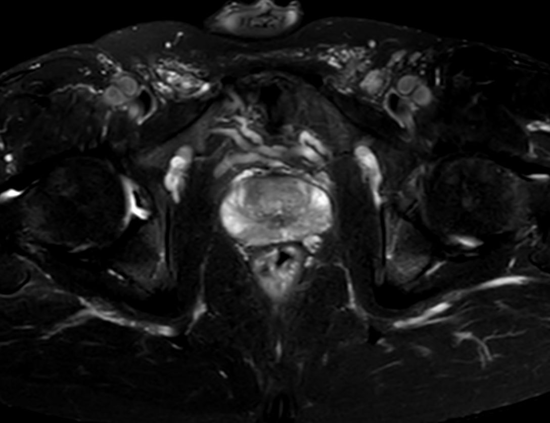 Axial T2w SPAIR<p>Compressed SENSE</p>
