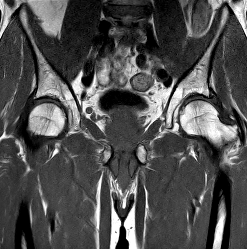 Coronal T1w TSE<p>Compressed SENSE</p>