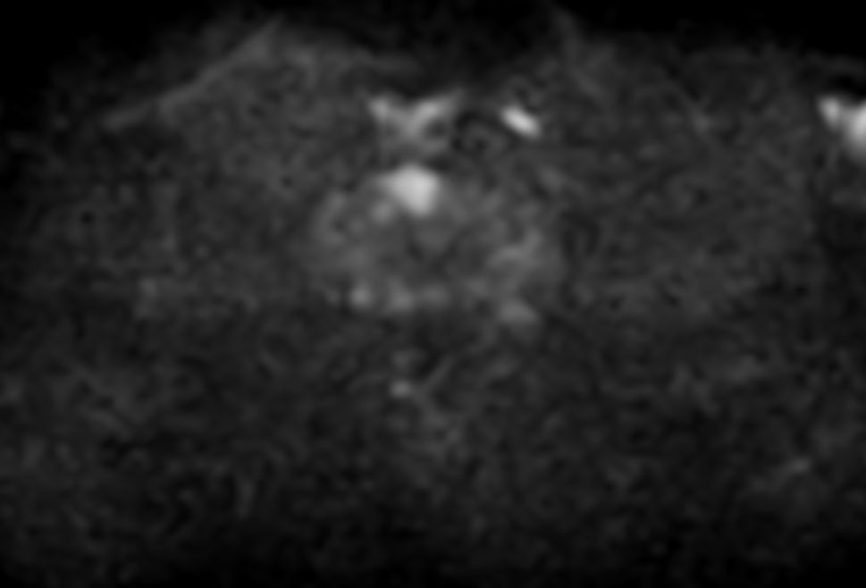Axial Diffusion (b1000)