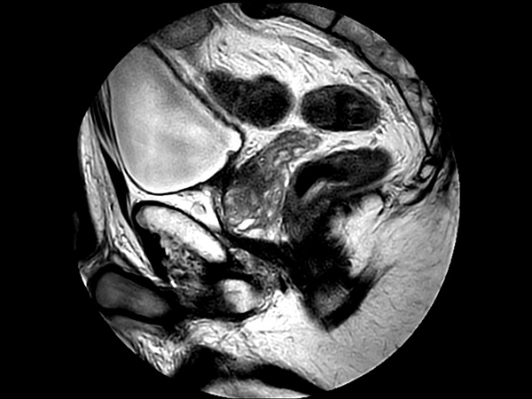 Sagittal T2w TSE MultiVane XD