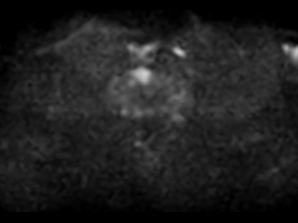 Axial Diffusion (b1000)