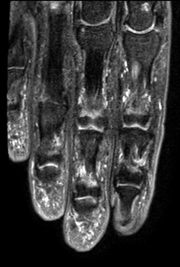 Coronal T2w TSE mDIXON XD