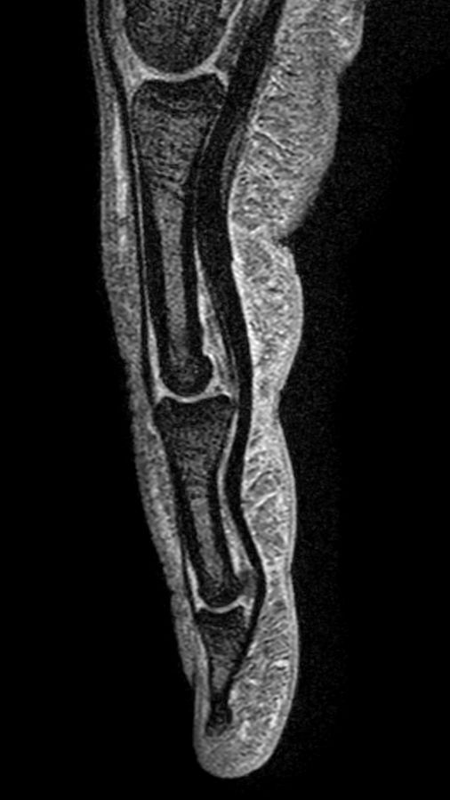 Sagittal mFFE (cumulative)