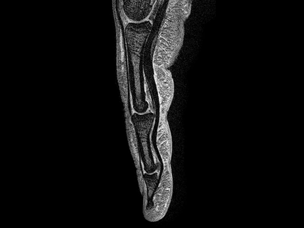 Sagittal mFFE (cumulative)