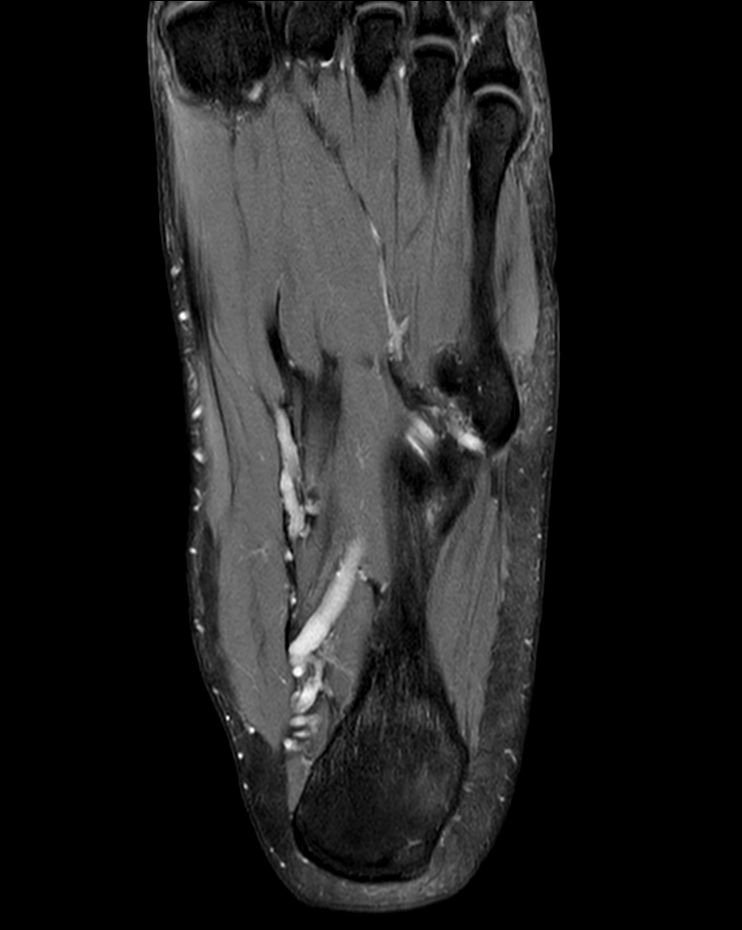Coronal PDw TSE mDIXON XD<b>Compressed SENSE</b>