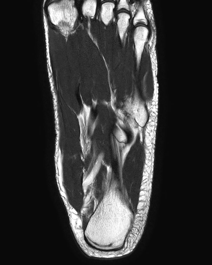 Coronal T2w TSE<b>Compressed SENSE</b>
