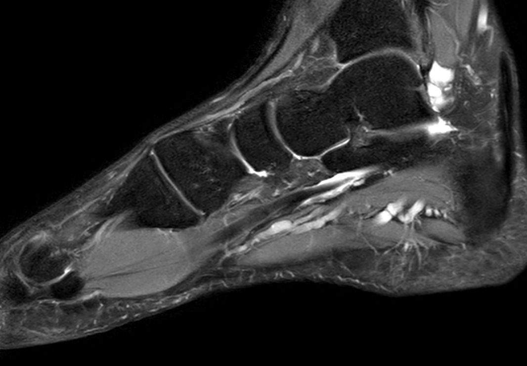 Sagittal PDw TSE mDIXON XD<b>Compressed SENSE</b>