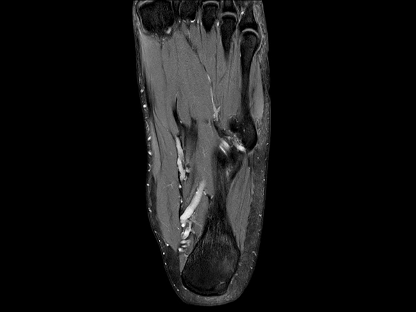 Coronal PDw TSE mDIXON XD<b>Compressed SENSE</b>