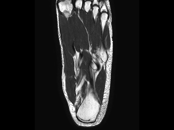 Coronal T2w TSE<b>Compressed SENSE</b>