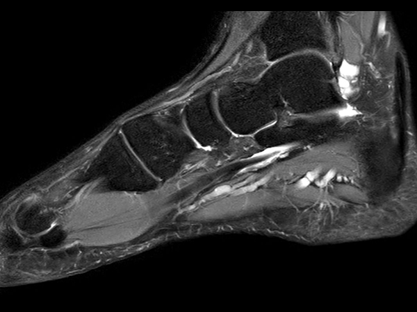 Sagittal PDw TSE mDIXON XD<b>Compressed SENSE</b>