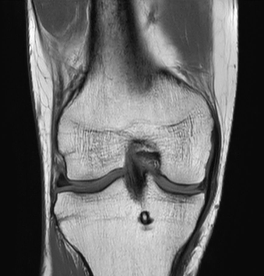 Coronal T1w TSE<b>Compressed SENSE</b>