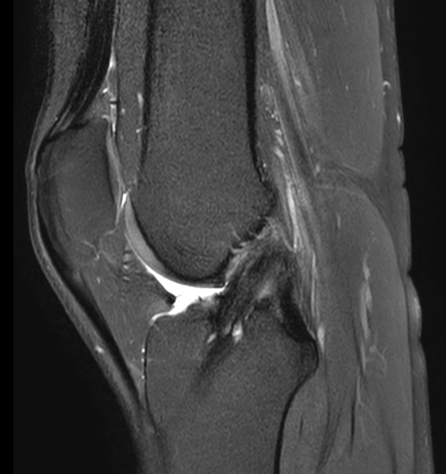 Sagittal PDw SPAIR<b>Compressed SENSE</b>