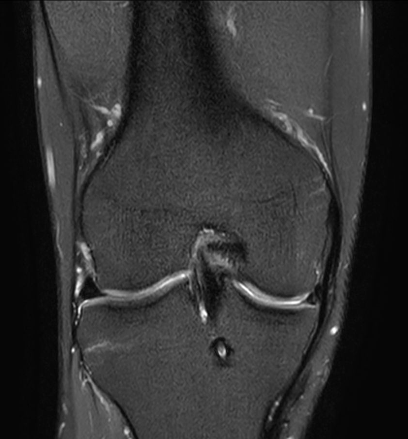 Coronal PDw SPAIR<b>Compressed SENSE</b>