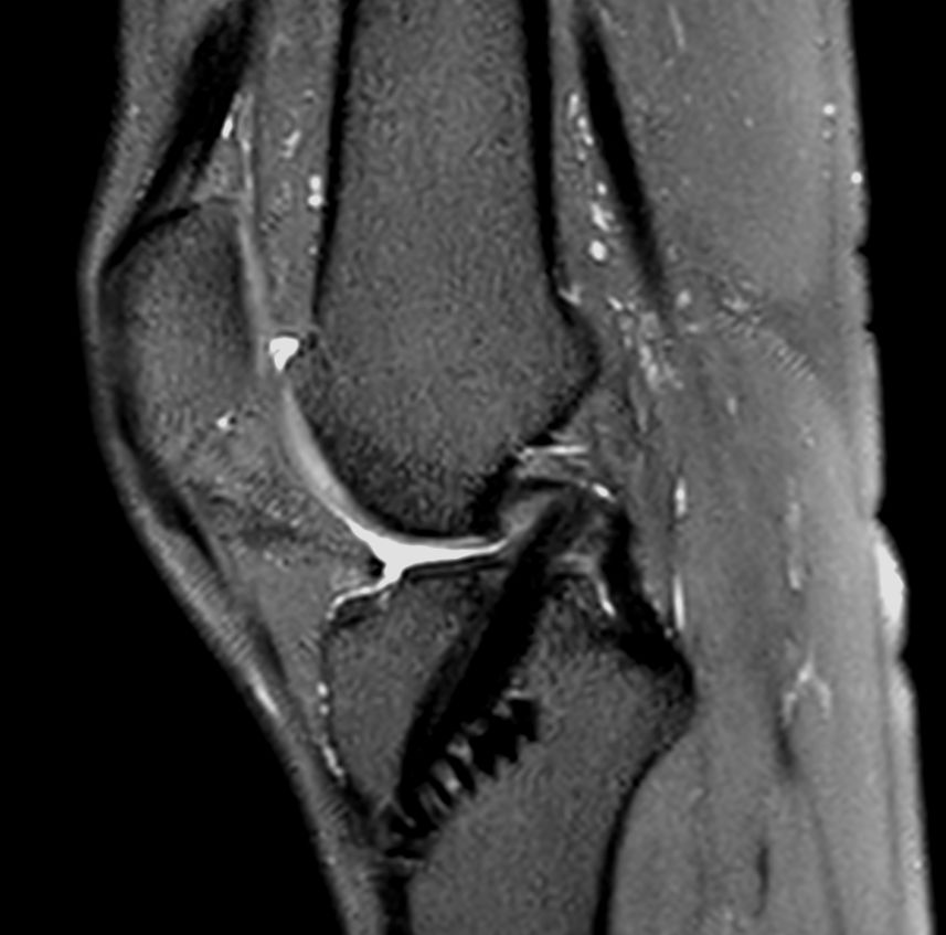 Sagittal 3D PDw SPAIR<b>Compressed SENSE</b>