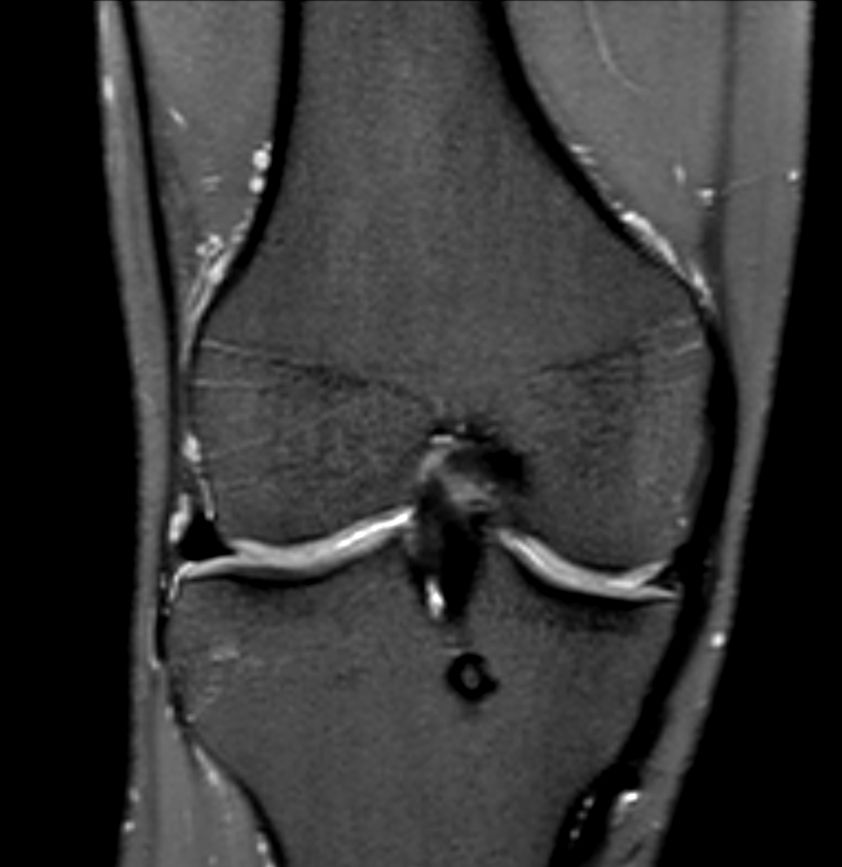 Coronal 3D PDw SPAIR (reformat)<b>Compressed SENSE</b>