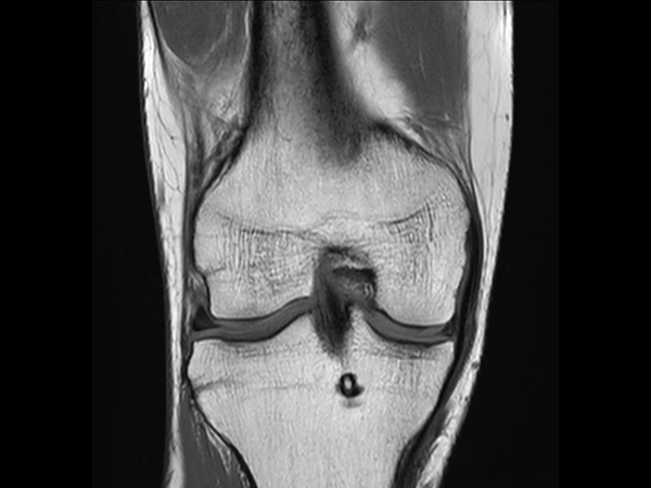 Coronal T1w TSE<b>Compressed SENSE</b>