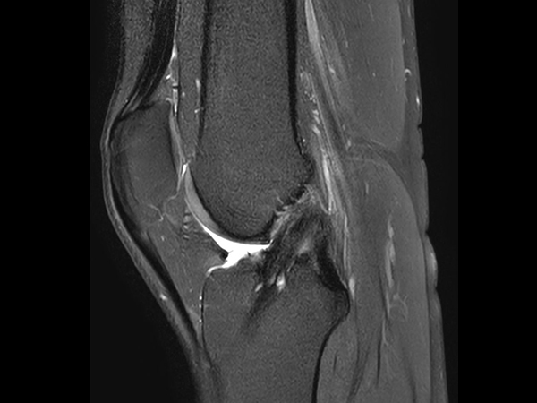 Sagittal PDw SPAIR<b>Compressed SENSE</b>