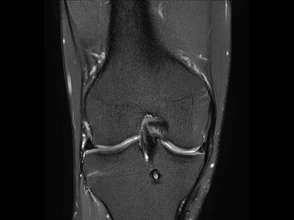 Coronal PDw SPAIR<b>Compressed SENSE</b>