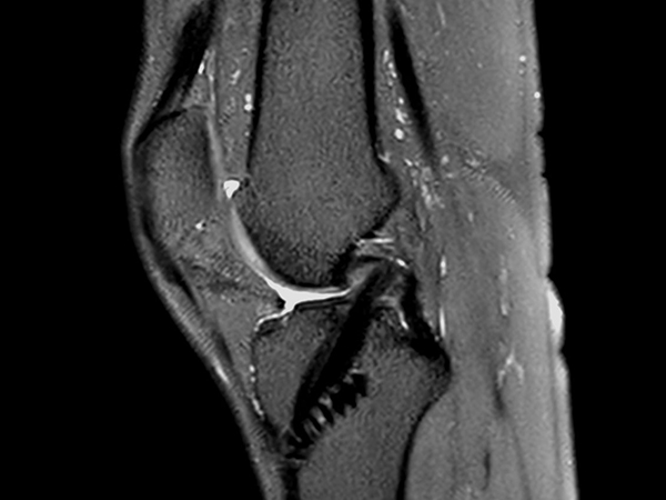 Sagittal 3D PDw SPAIR<b>Compressed SENSE</b>