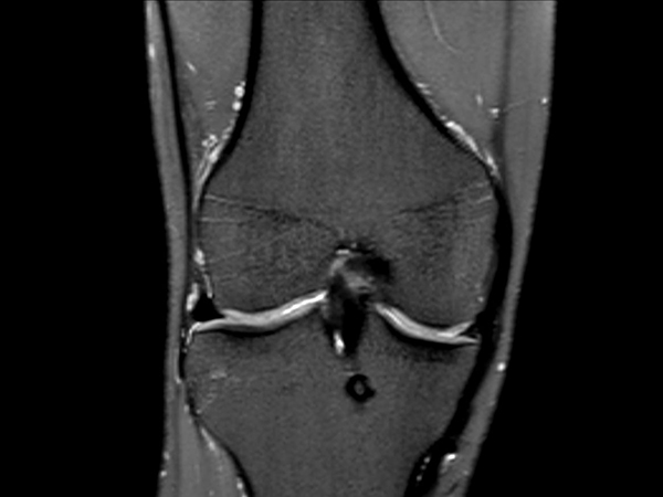 Coronal 3D PDw SPAIR (reformat)<b>Compressed SENSE</b>