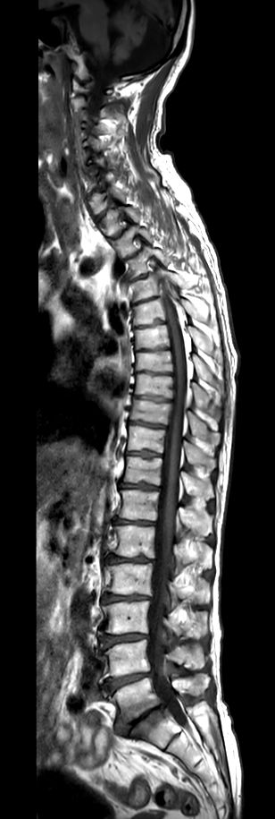 Sagittal T1w TSE (2 stations)<b>Compressed SENSE</b>