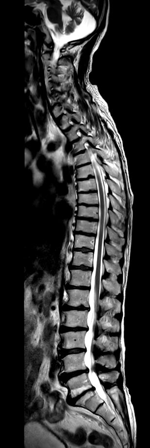 Sagittal T2w TSE (2 stations)<b>Compressed SENSE</b>