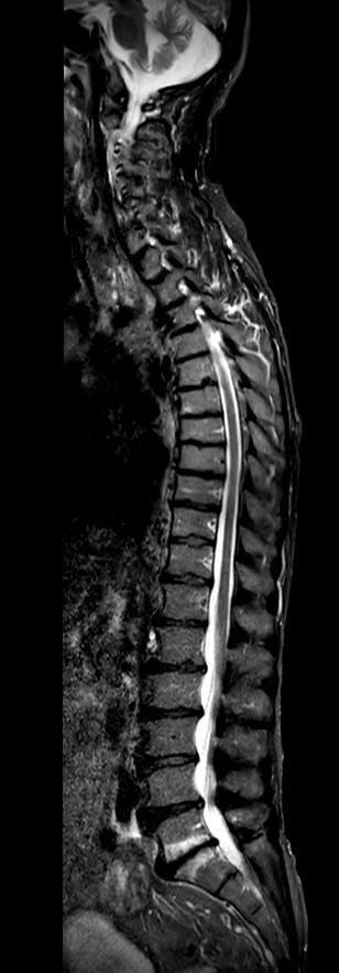 Sagittal STIR TSE (2 stations)<b>Compressed SENSE</b>