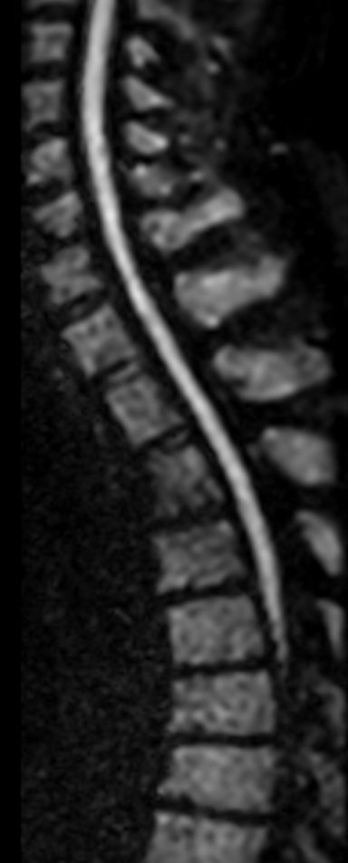 Sagittal Diffusion IRIS Zoom (b800)