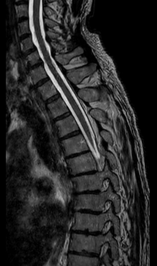 Sagittal 3D T2w TSE (SpineVIEW)<b>Compressed SENSE</b>