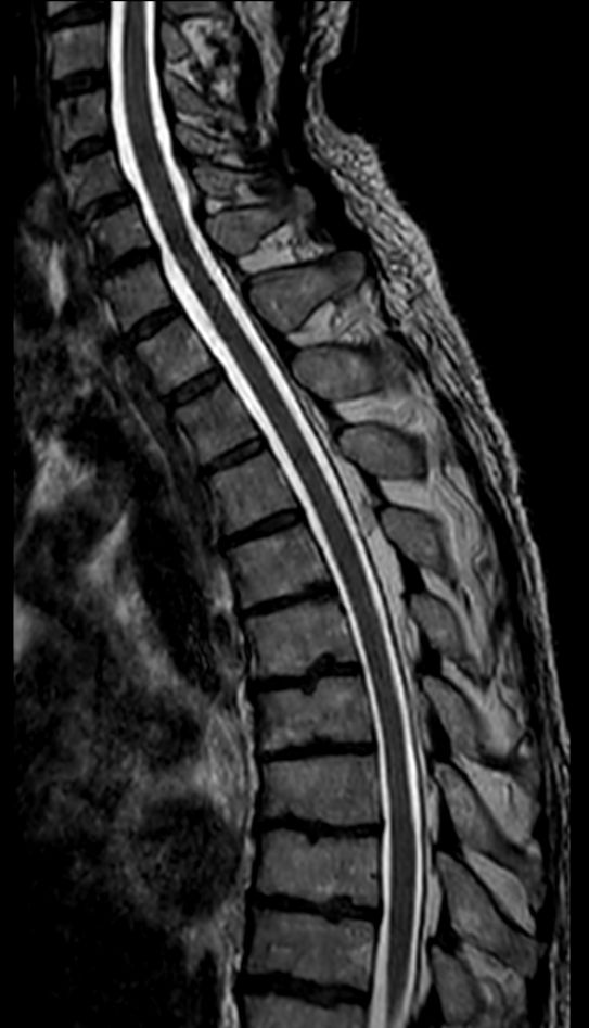 3D T2w TSE (SpineVIEW) - Oblique reformat<b>Compressed SENSE</b>