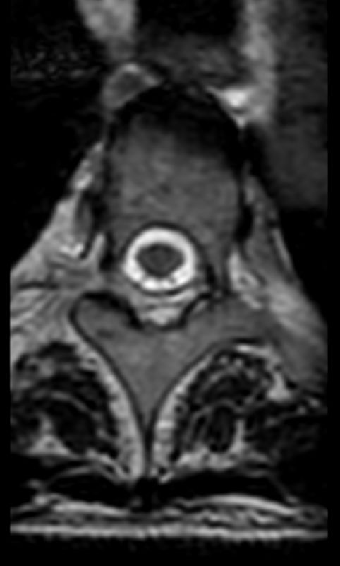 3D T2w TSE (SpineVIEW) - Axial reformat<b>Compressed SENSE</b>
