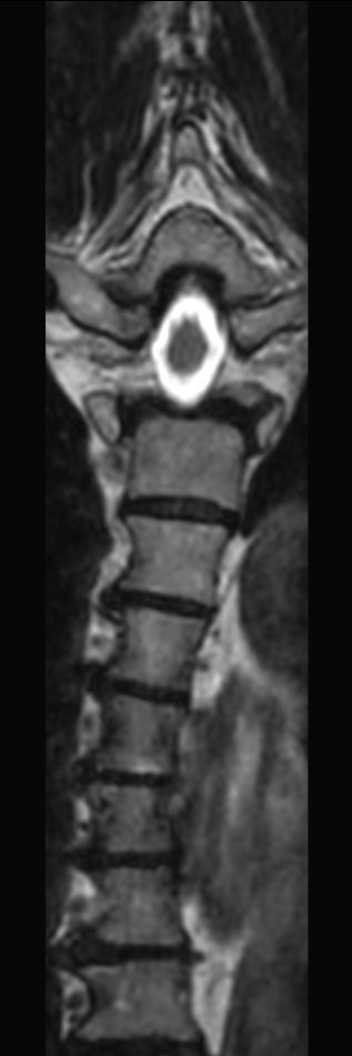 3D T2w TSE (SpineVIEW) - Coronal reformat<b>Compressed SENSE</b>