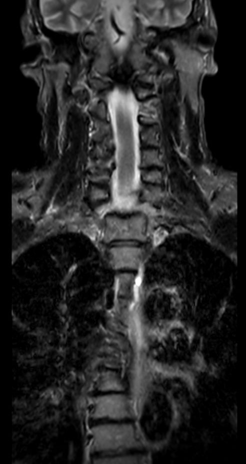 Coronal STIR TSE<b>Compressed SENSE</b>