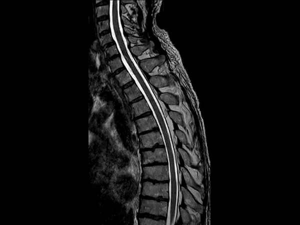 3D T2w TSE (SpineVIEW) - Oblique reformat<b>Compressed SENSE</b>