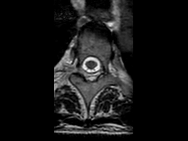 3D T2w TSE (SpineVIEW) - Axial reformat<b>Compressed SENSE</b>