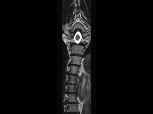 3D T2w TSE (SpineVIEW) - Coronal reformat<b>Compressed SENSE</b>