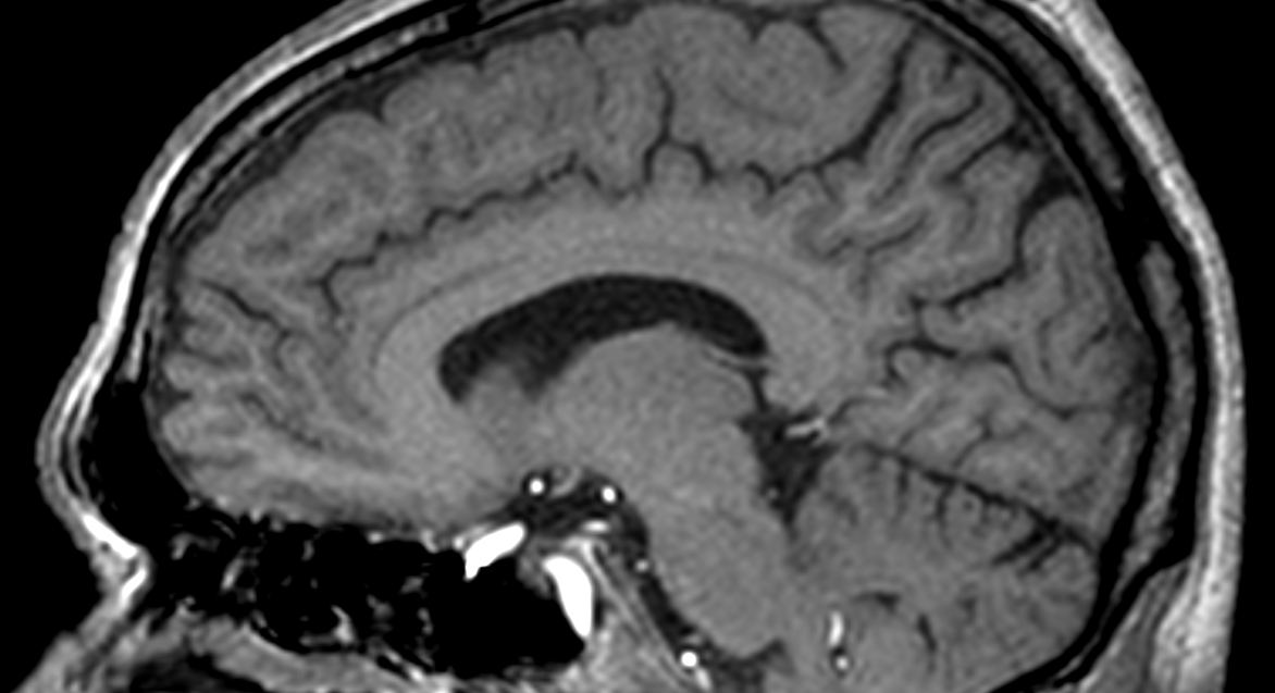 3D T1w TFE (sagittal reformat)