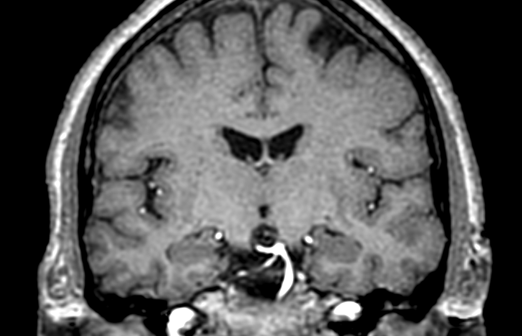 3D T1w TFE (coronal reformat)
