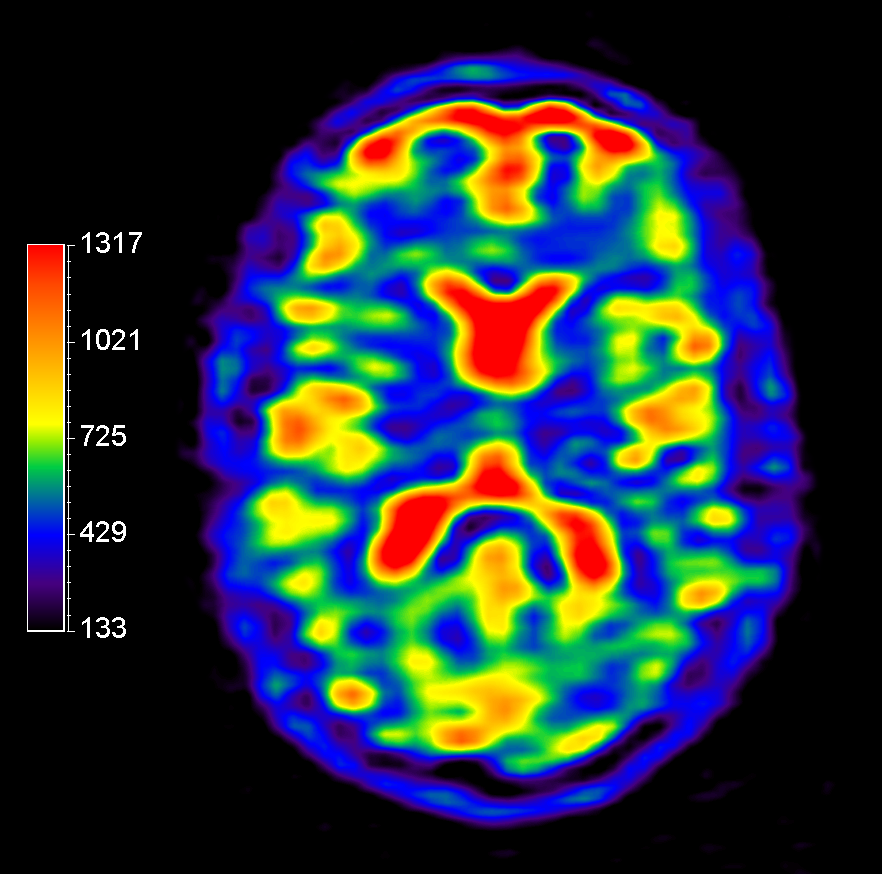 23Na bFFE (axial reformat)