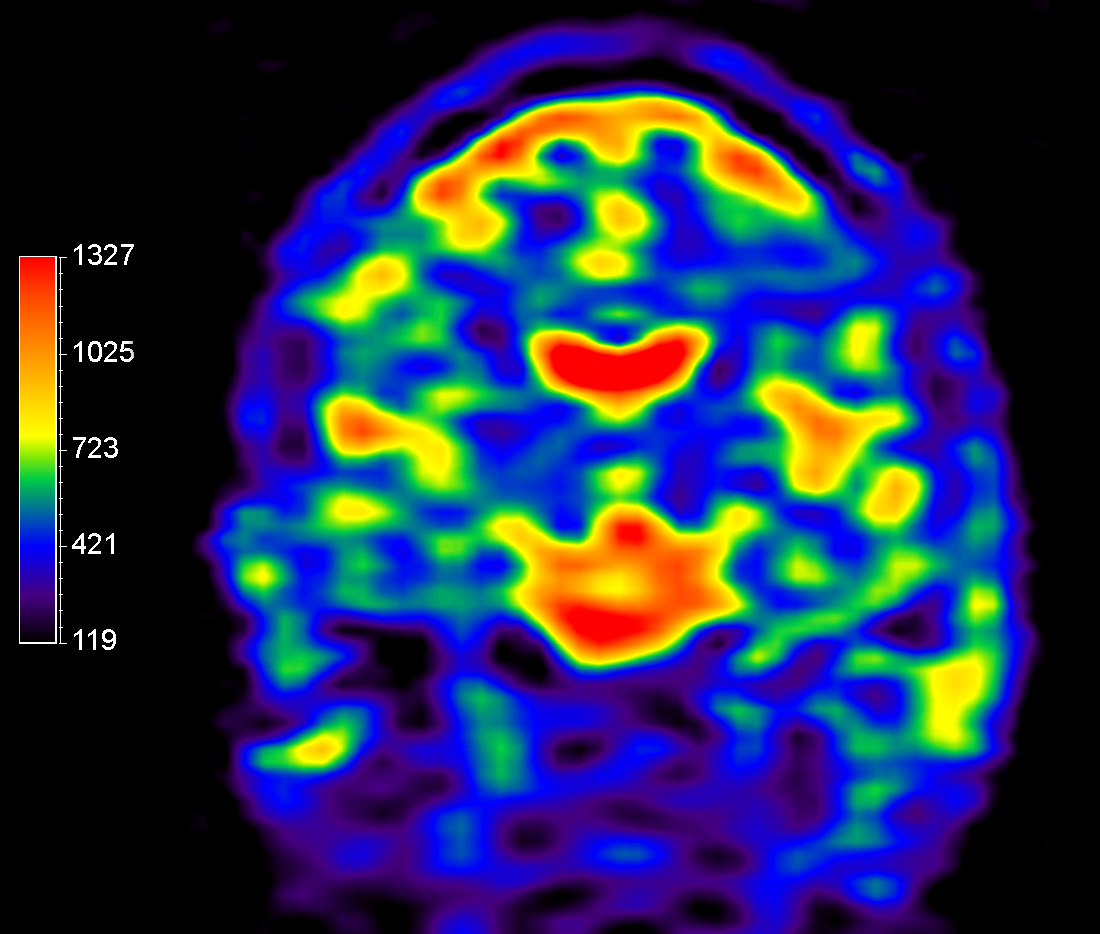23Na bFFE (coronal reformat)