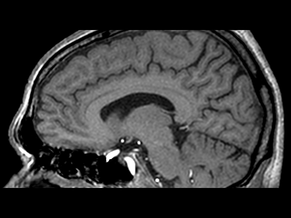 3D T1w TFE (sagittal reformat)