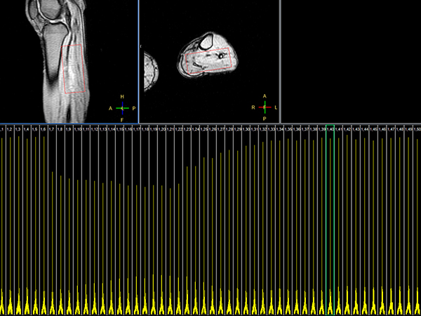 31P Phase Acquired (5 sec/acq, 50 dynamics)