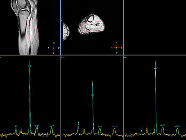 31P Phase Acquired (Rest - Stress - Recovery)