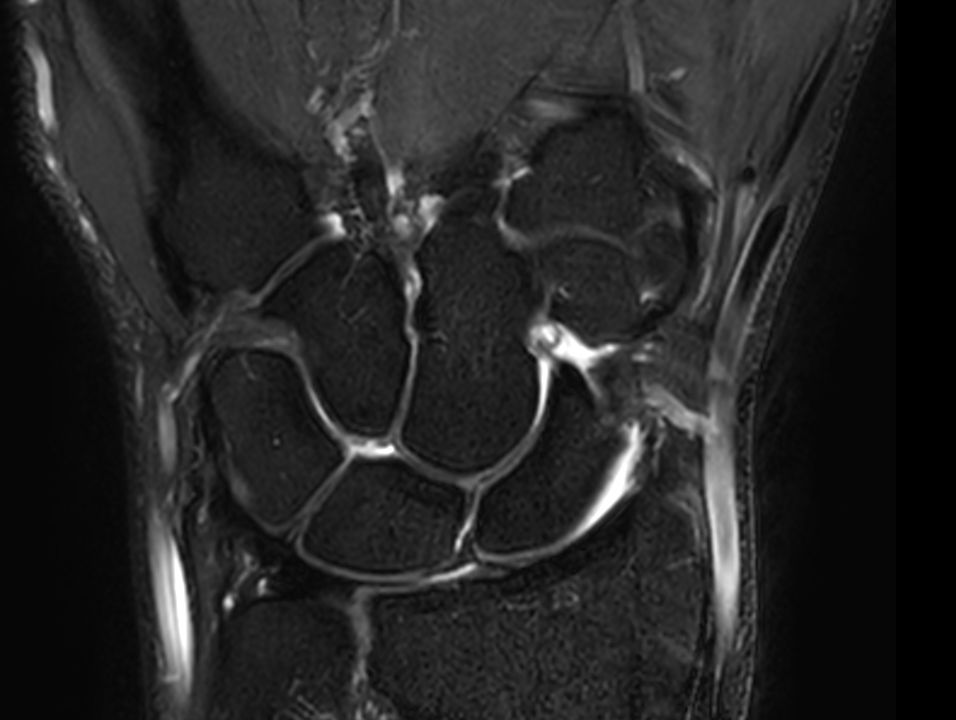 Coronal T2w TSE FatSat